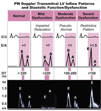 moderate lv dysfunction|is impaired lv relaxation dangerous.